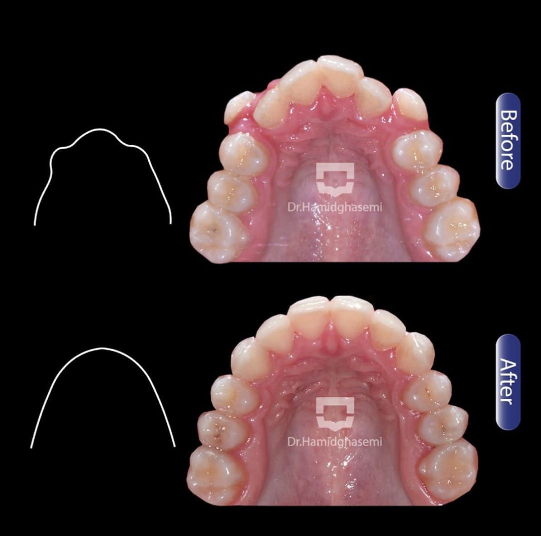 قبل و بعد درمان نامرتبی دندان