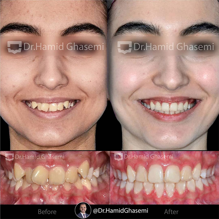 نمونه درمان ارتودنسی M.97_1375