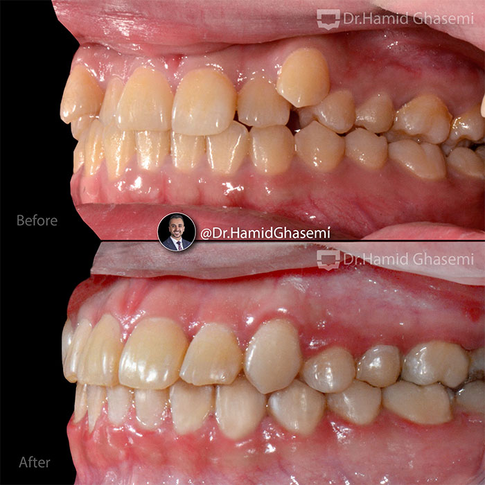 نمونه درمان ارتودنسی M.97_1400