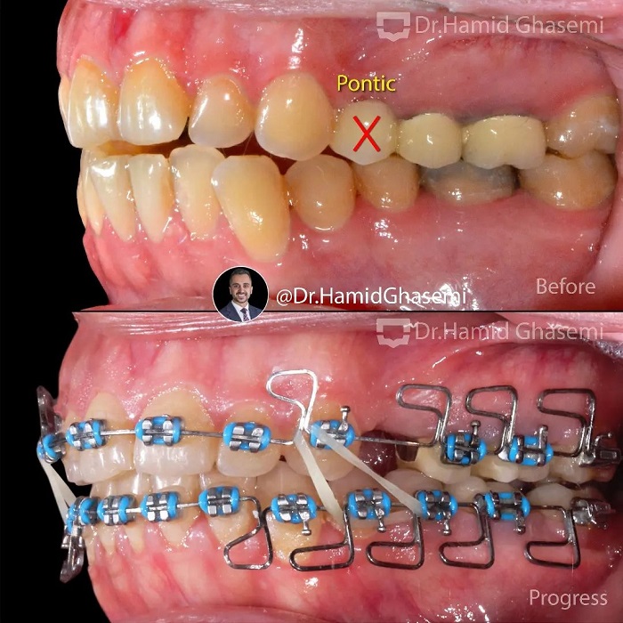 نمونه درمان ارتودنسی M.00_1876