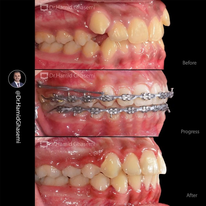 نمونه درمان ارتودنسی M.98_1467