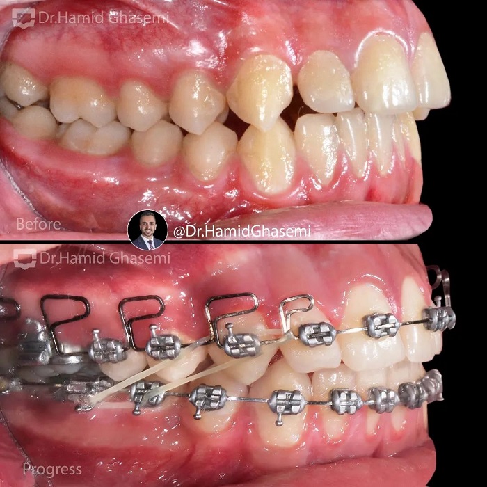 نمونه درمان ارتودنسی M.98_1543