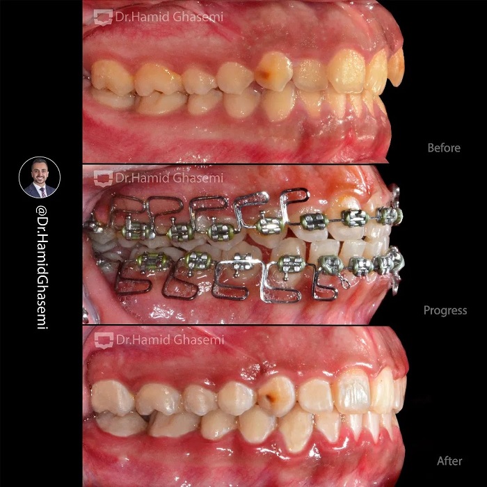 نمونه درمان ارتودنسی M.98_1511