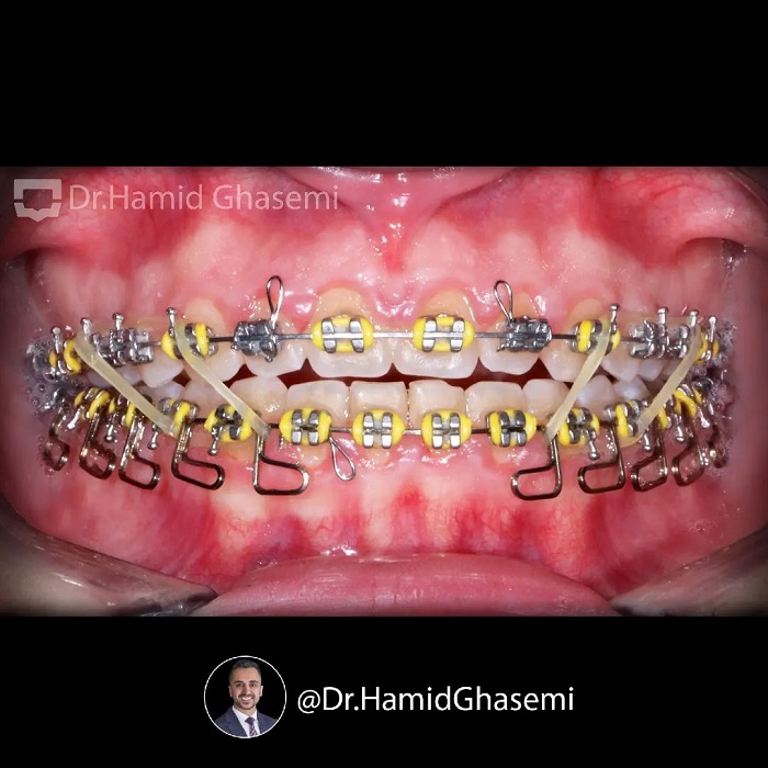 نمونه درمان ارتودنسی M.98_1438