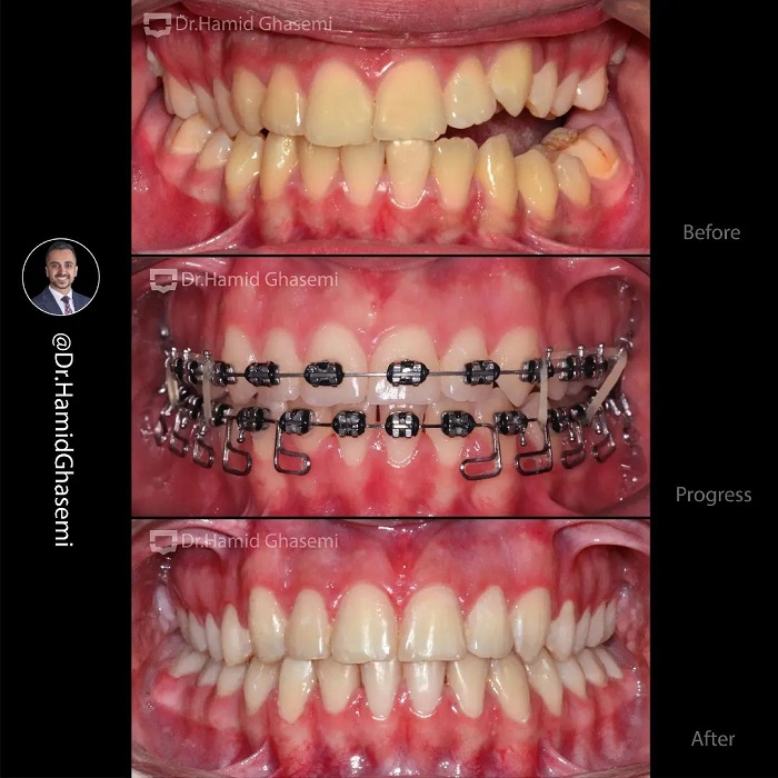 نمونه درمان ارتودنسی M.97_1356