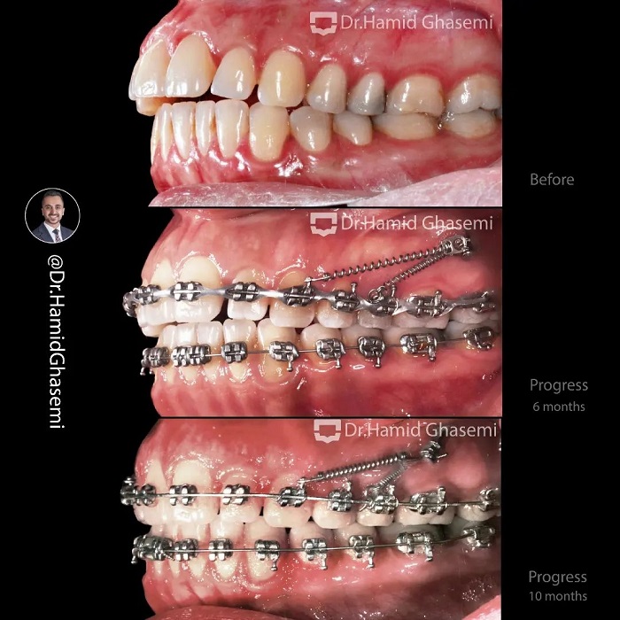 نمونه درمان ارتودنسی M.00_1883