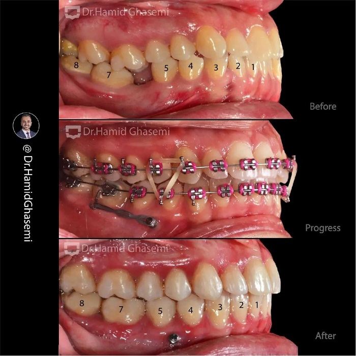 نمونه درمان ارتودنسی M.97_1399