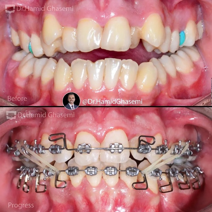 نمونه درمان ارتودنسی M.98_1523