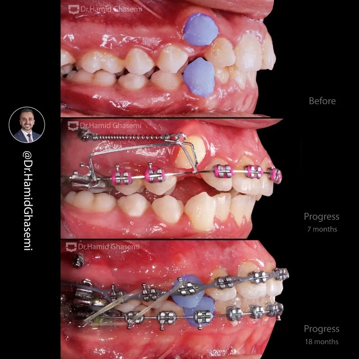 نمونه درمان ارتودنسی M.99__1693