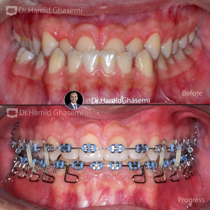نمونه درمان ارتودنسی M.99_1735