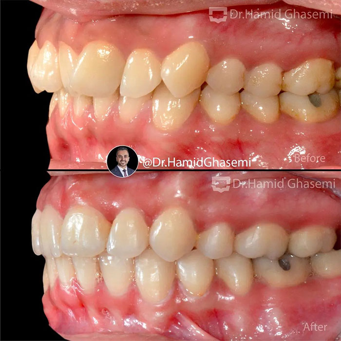 نمونه درمان ارتودنسی M.97_1314