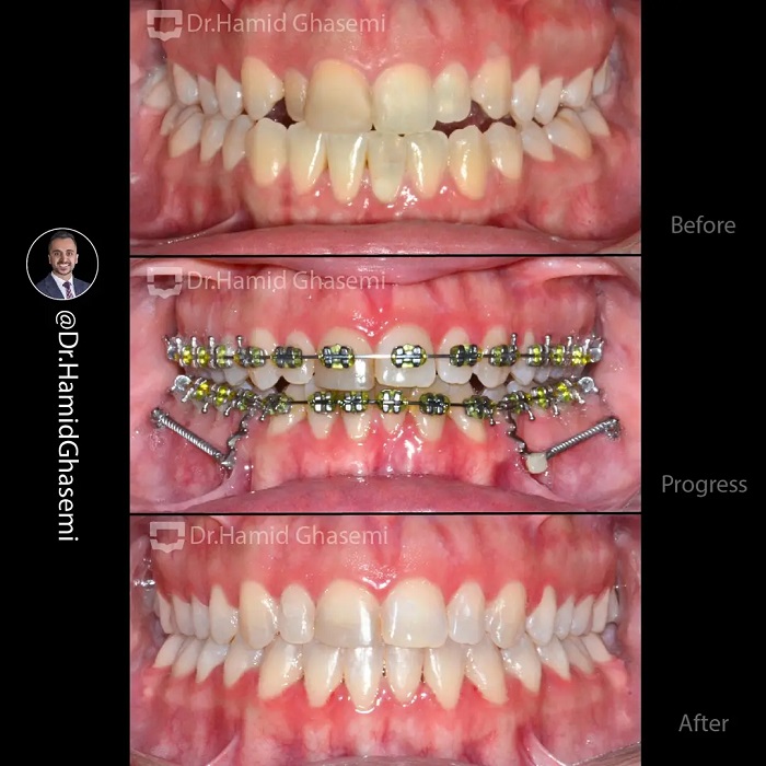 نمونه درمان ارتودنسی M.98_1549