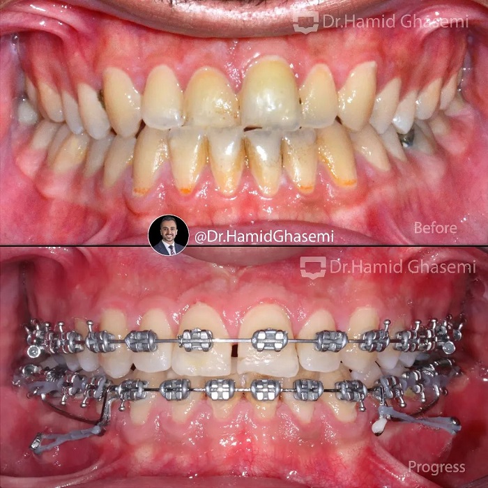 نمونه درمان ارتودنسی M.99_1733