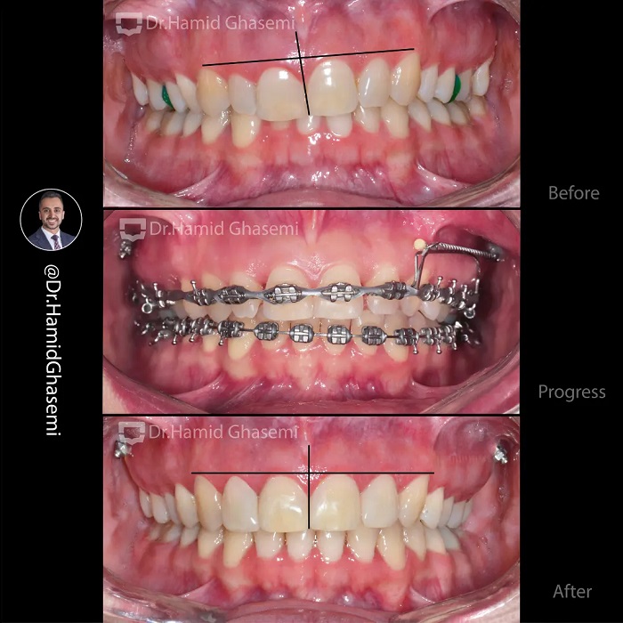 نمونه درمان ارتودنسی M.99_1833