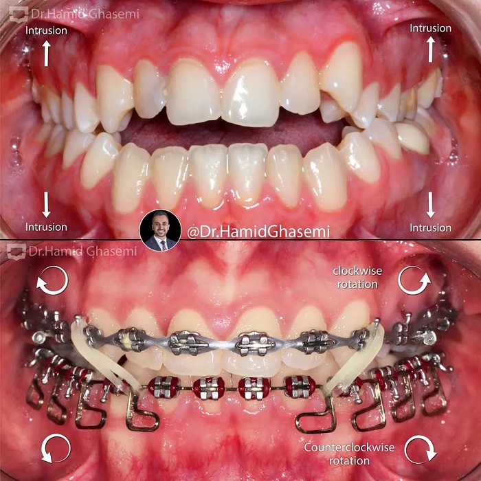 نمونه درمان ارتودنسی M.98_1637