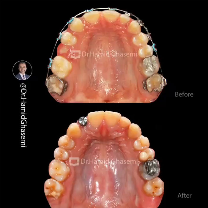 نمونه درمان ارتودنسی M.96_1022