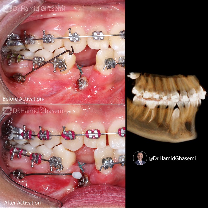 نمونه درمان ارتودنسی M.99_1823