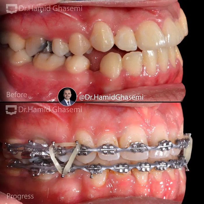 نمونه درمان ارتودنسی M.98_1505