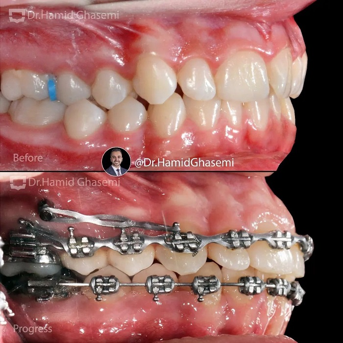 نمونه درمان ارتودنسی M.99_1701