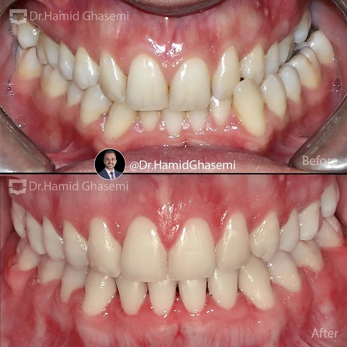 نمونه درمان ارتودنسی M.99_1778