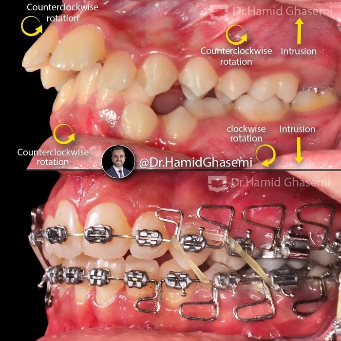 نمونه درمان ارتودنسی M.98_1537