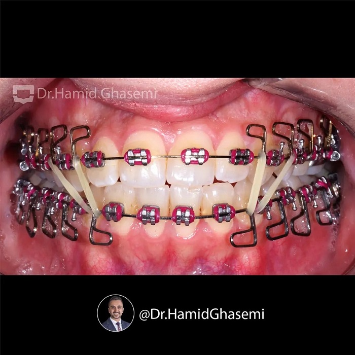 نمونه درمان ارتودنسی M.99_1764