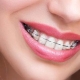 بهترین نوع ارتودنسی دندان