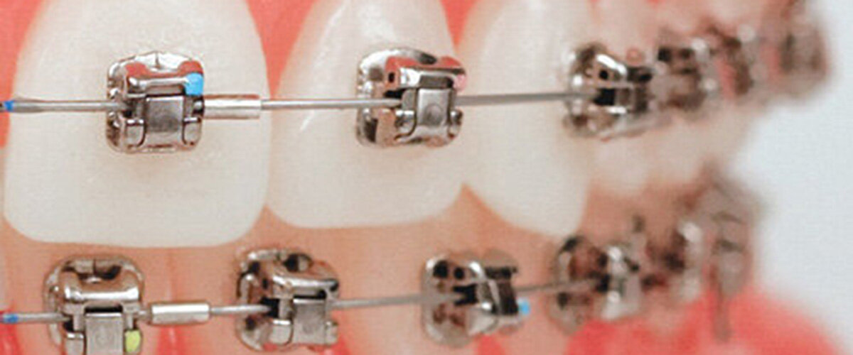 damon ارتودنسی دیمون در کرج